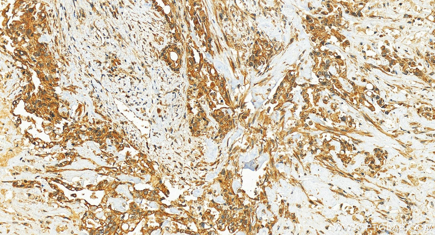 IHC staining of human intrahepatic cholangiocarcinoma using 10125-2-AP (same clone as 10125-2-PBS)