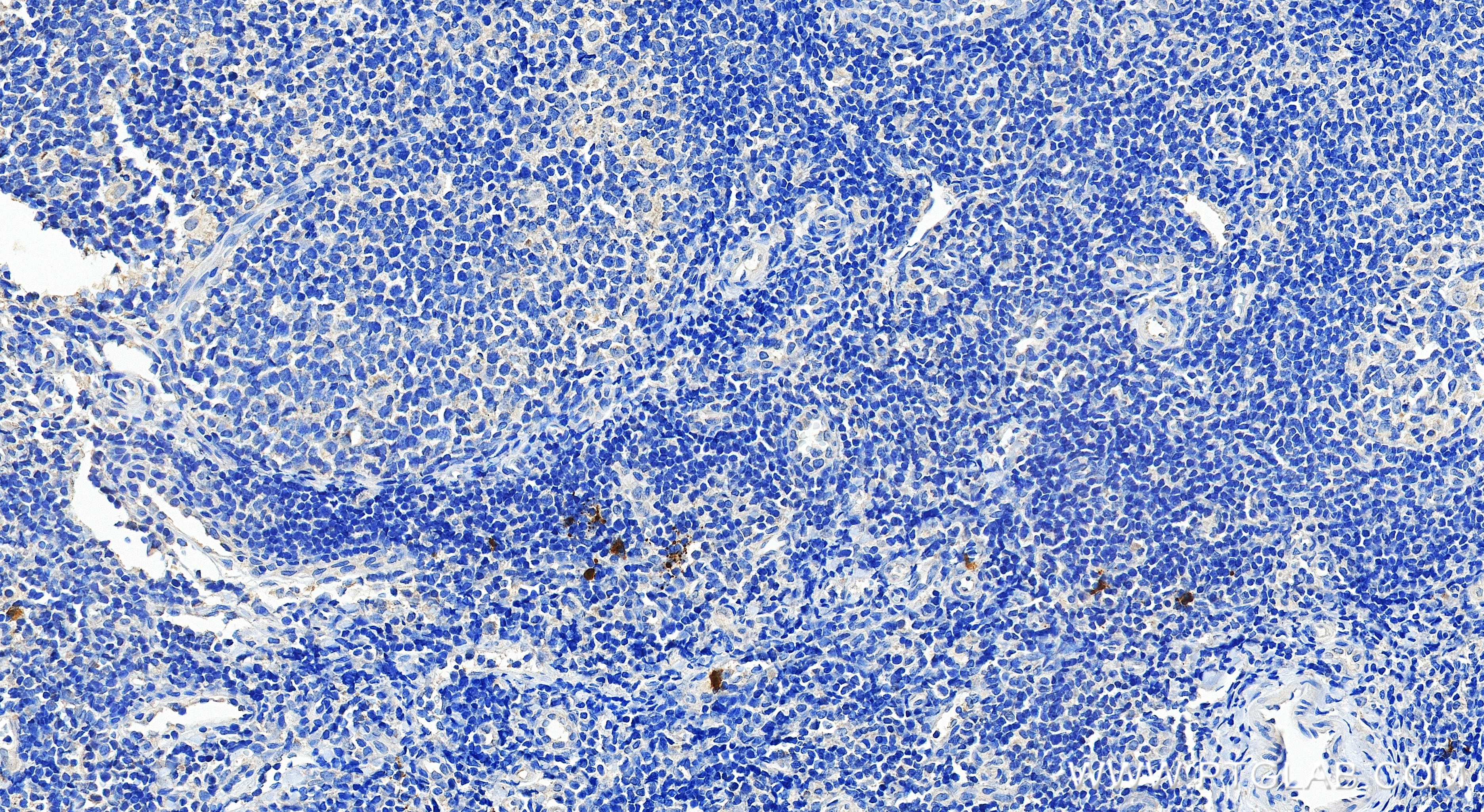 IHC staining of human tonsillitis using 85168-2-RR IHC staining of human tonsillitis using 85168-2-RR