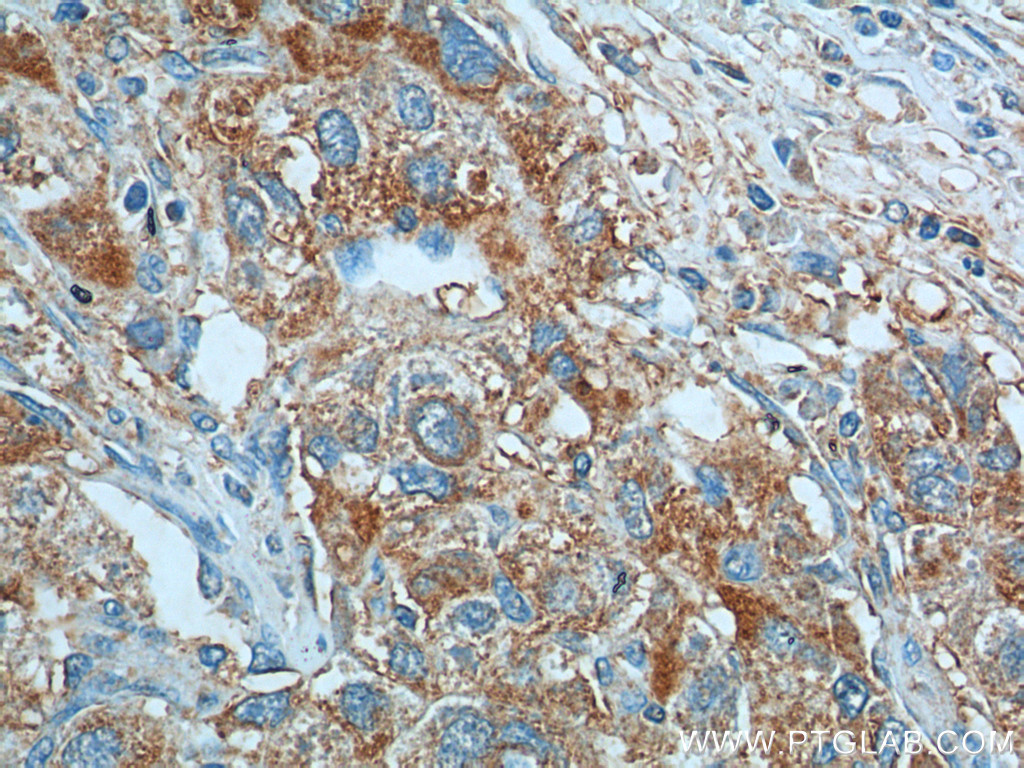 IHC staining of human liver cancer using 18375-1-AP