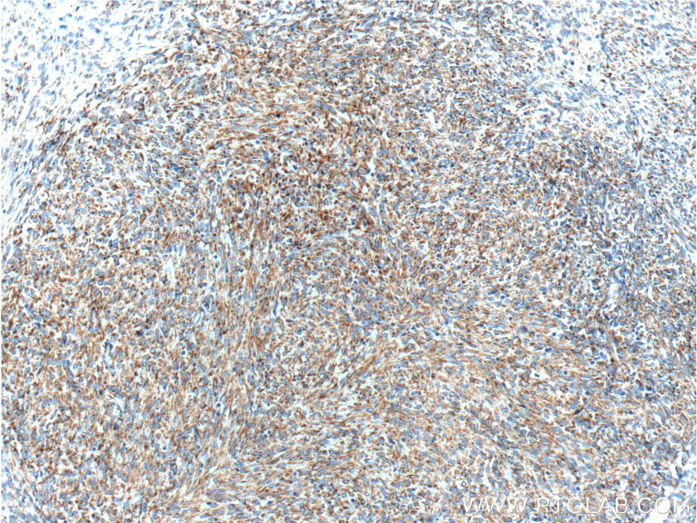 IHC staining of stromal tumor using 18696-1-AP