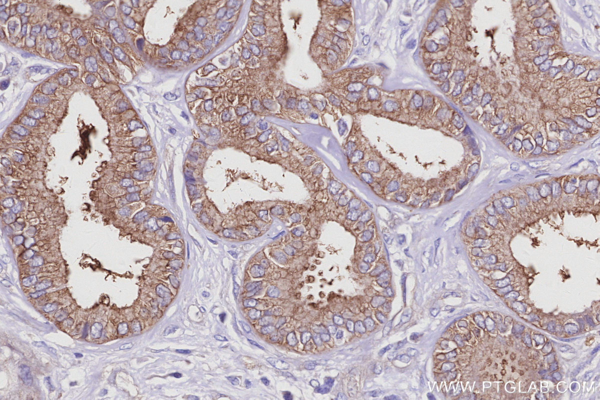 IHC staining of human pancreas cancer using 16493-1-AP IHC staining of human pancreas cancer using 16493-1-AP