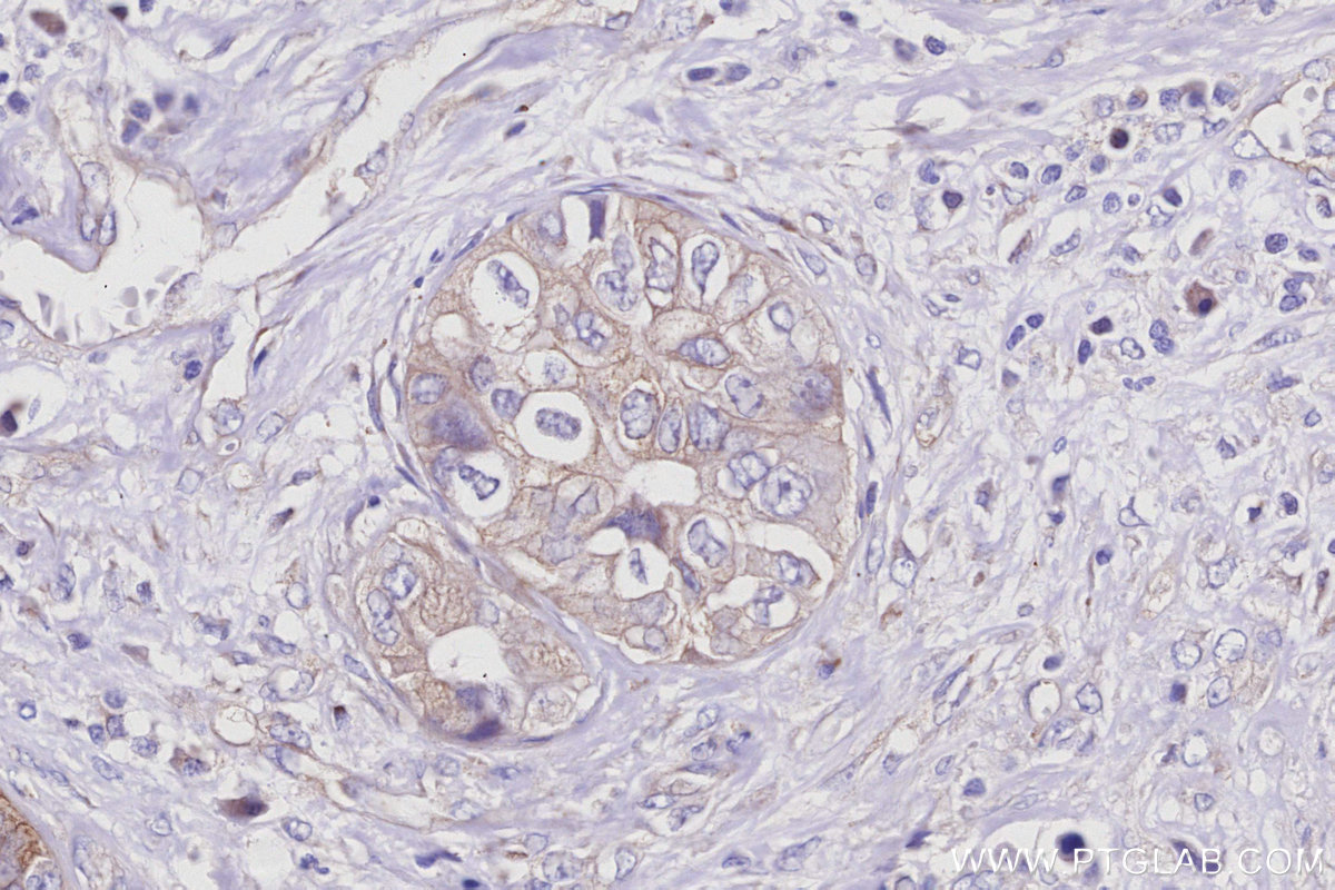 IHC staining of human pancreas cancer using 16493-1-AP IHC staining of human pancreas cancer using 16493-1-AP
