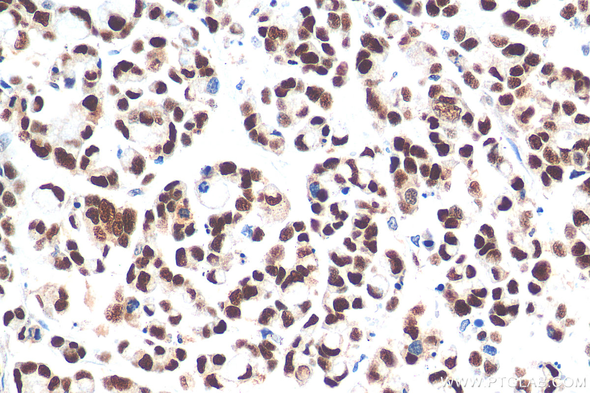 IHC staining of human colon cancer using 21017-1-AP