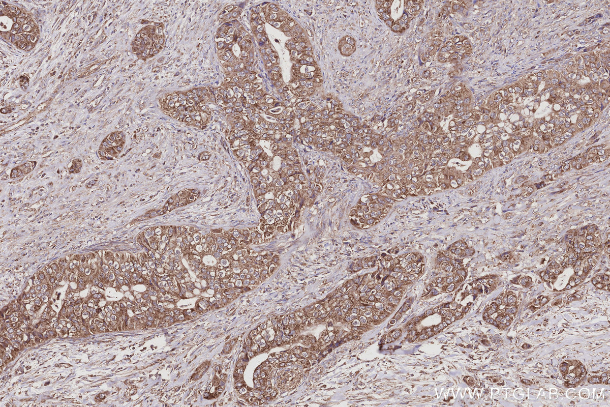 IHC staining of human pancreas cancer using 24847-1-AP IHC staining of human pancreas cancer using 24847-1-AP