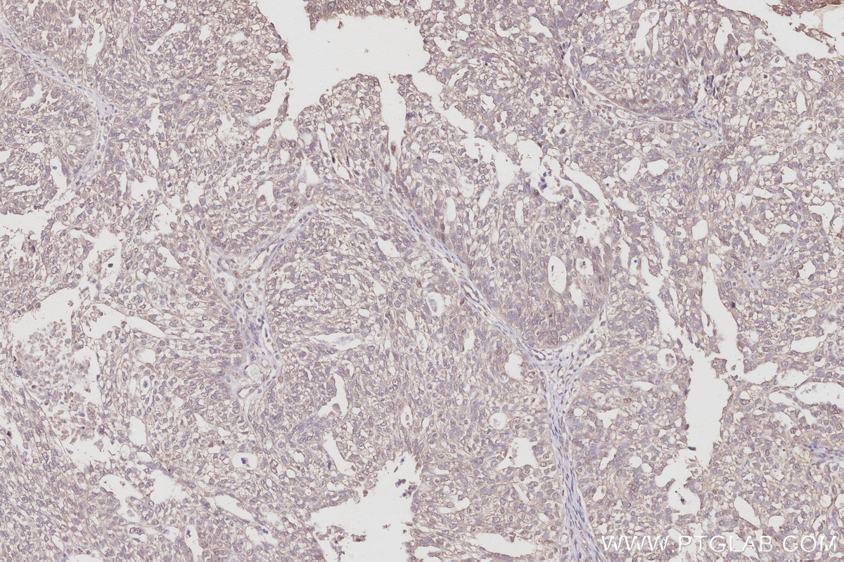 IHC staining of human ovary cancer using 16952-1-AP IHC staining of human ovary cancer using 16952-1-AP
