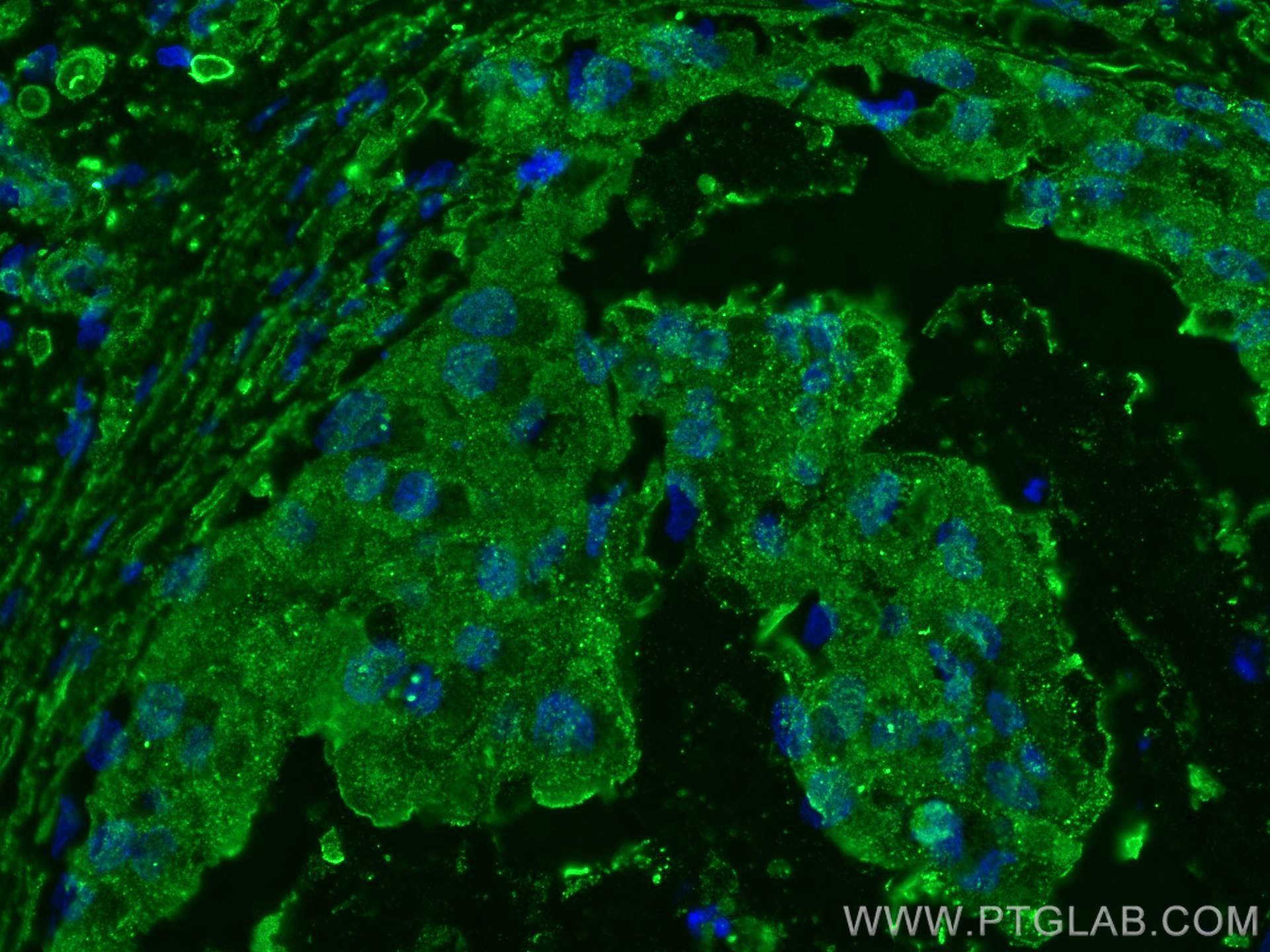 IF Staining of human breast cancer using 67427-1-Ig (same clone as 67427-1-PBS)