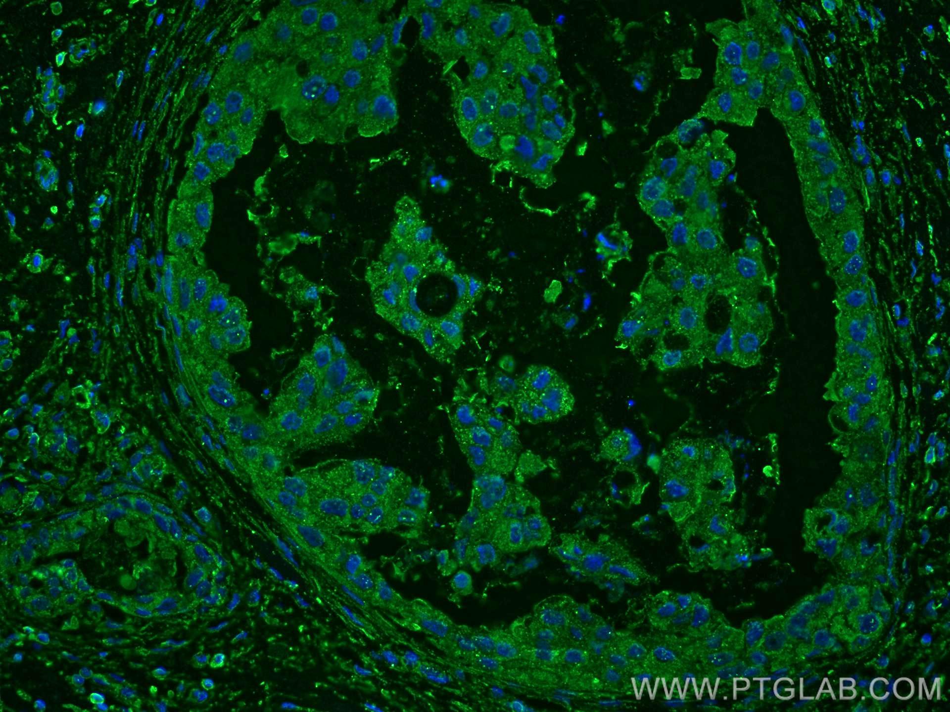 IF Staining of human breast cancer using 67427-1-Ig (same clone as 67427-1-PBS)