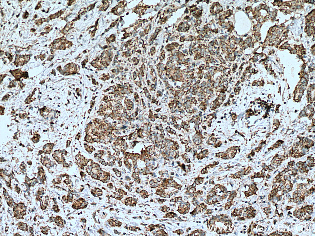 IHC staining of human breast cancer using 67427-1-Ig