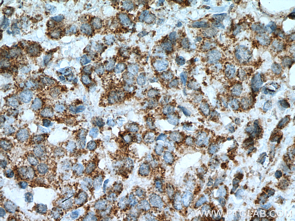 IHC staining of human breast cancer using 67427-1-Ig (same clone as 67427-1-PBS)