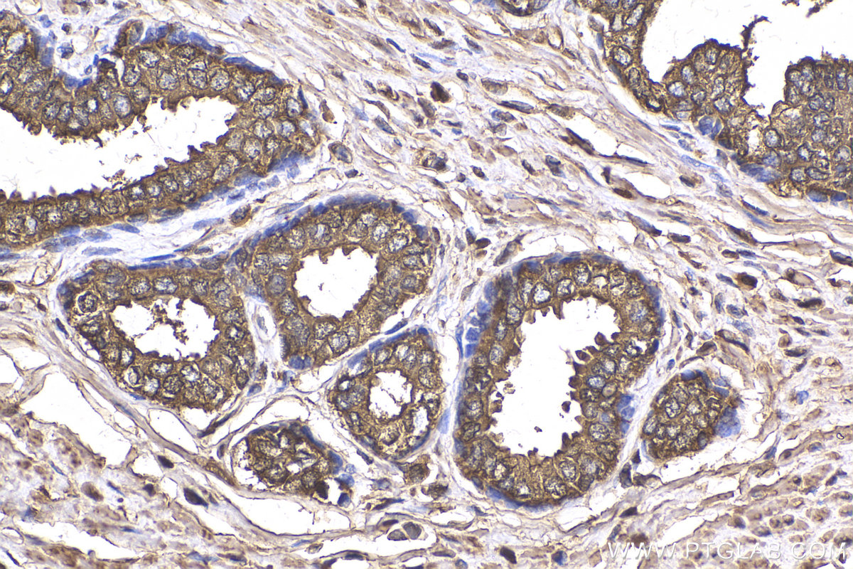 IHC staining of human prostate cancer using 10679-1-AP