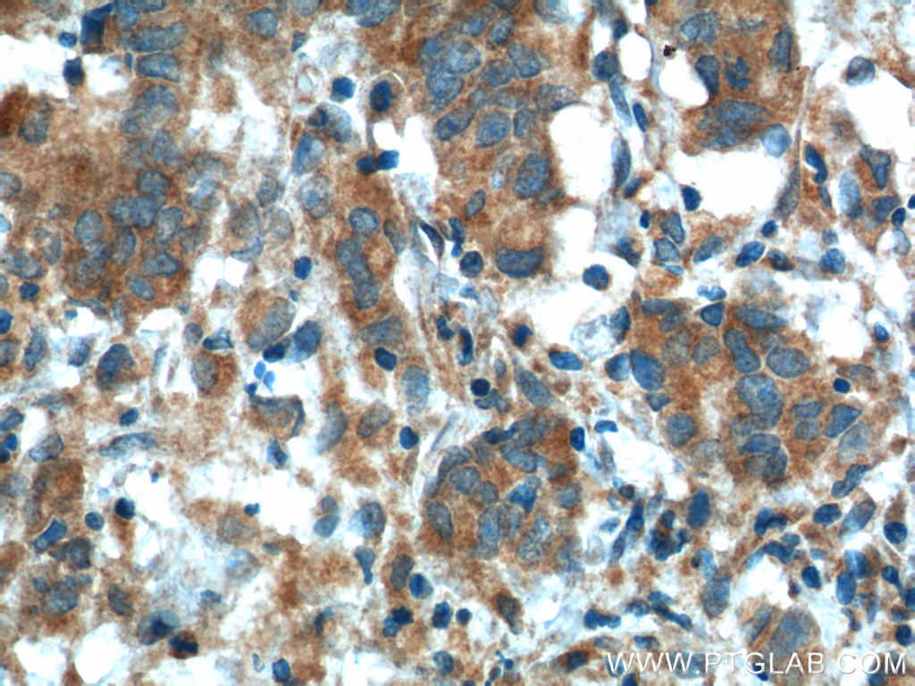 IHC staining of human prostate cancer using 10679-1-AP