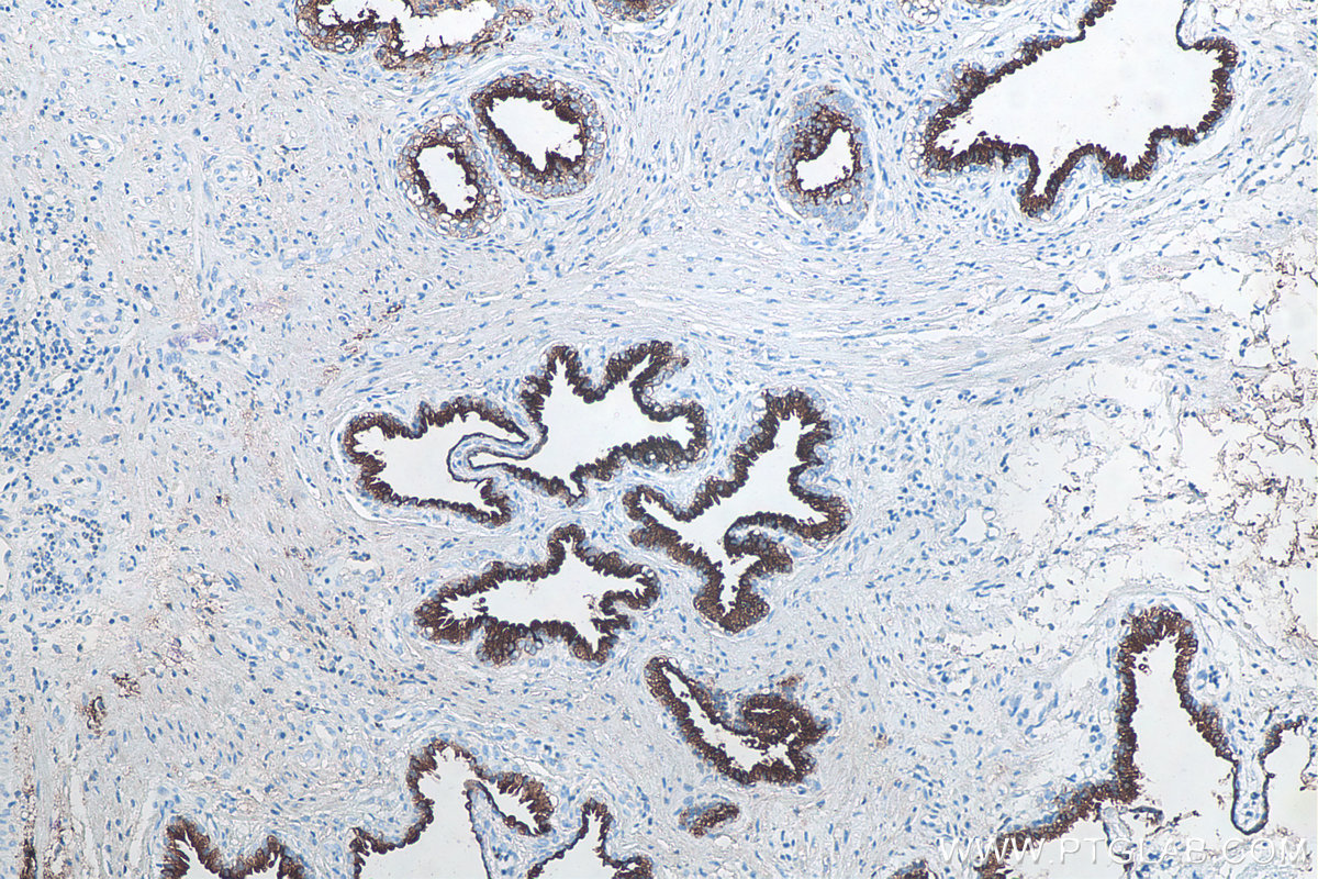 IHC staining of human prostate cancer using 60338-1-Ig IHC staining of human prostate cancer using 60338-1-Ig