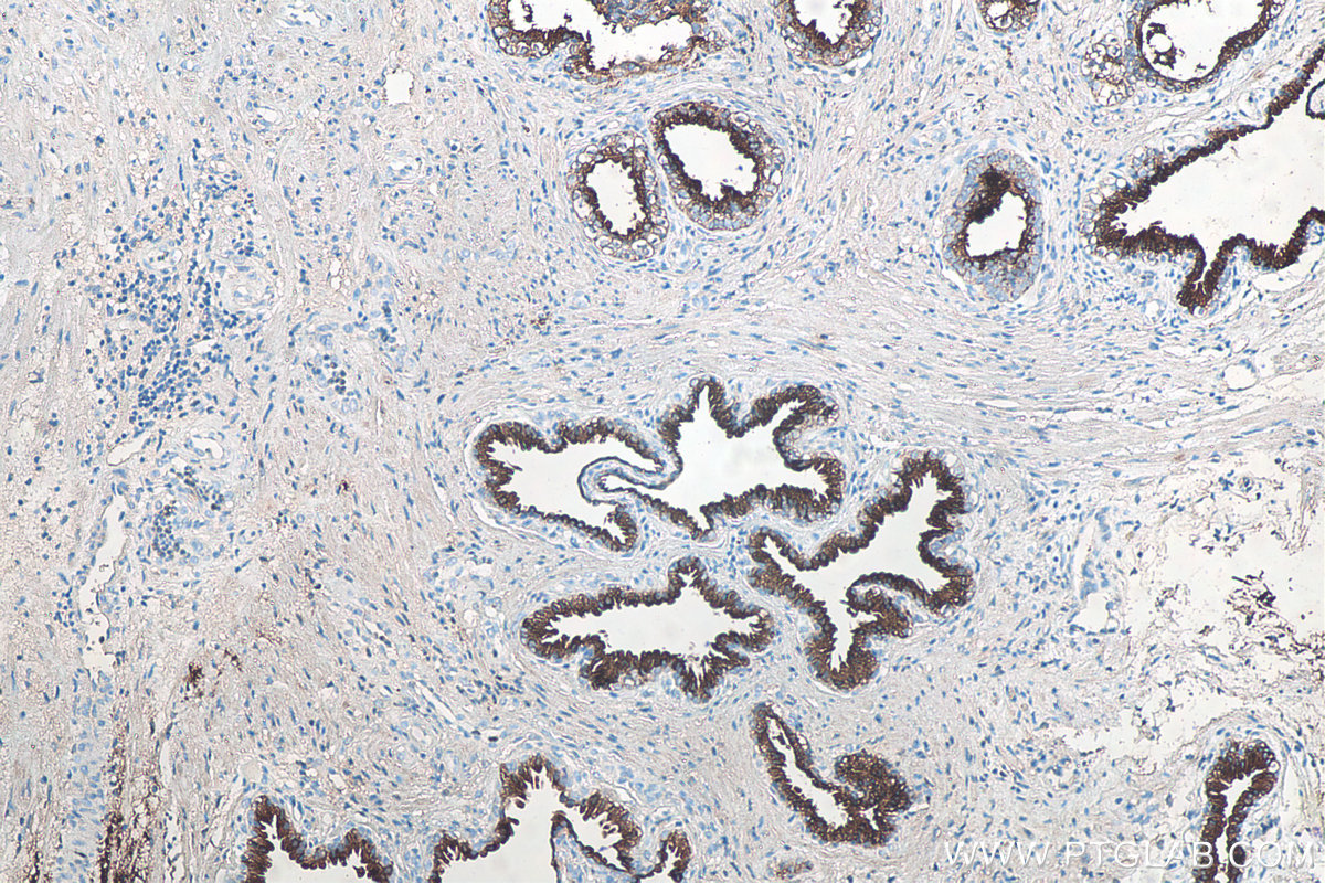IHC staining of human prostate cancer using 60338-1-Ig
