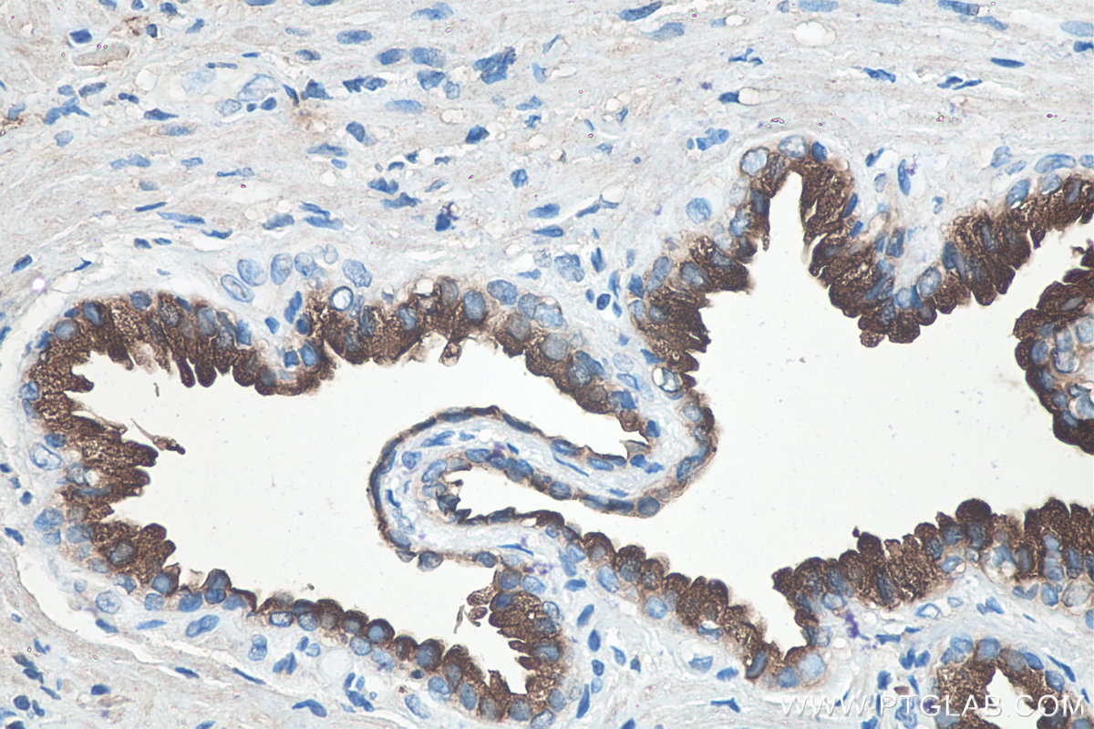 IHC staining of human prostate cancer using 60338-1-Ig