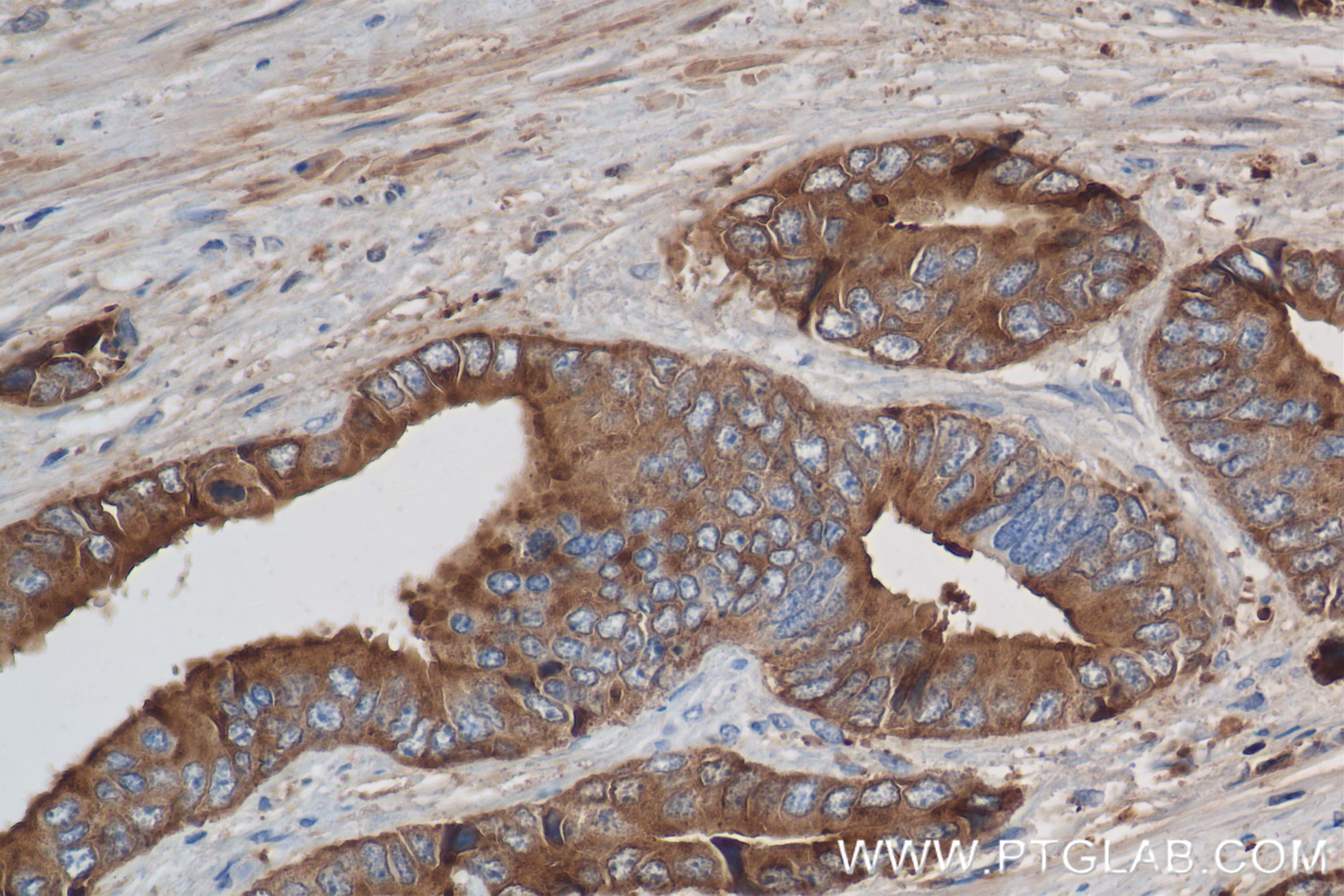 IHC staining of human prostate cancer using 84059-5-RR