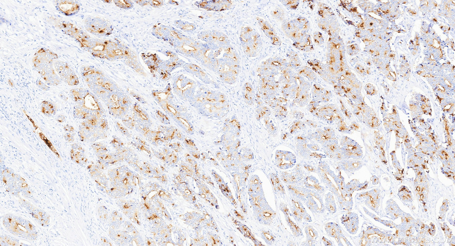 IHC staining of human prostate cancer using 84059-6-RR IHC staining of human prostate cancer using 84059-6-RR