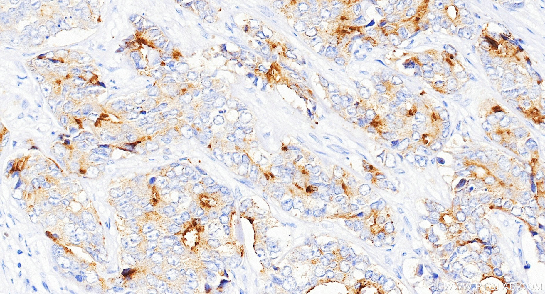 IHC staining of human prostate cancer using 84059-6-RR IHC staining of human prostate cancer using 84059-6-RR