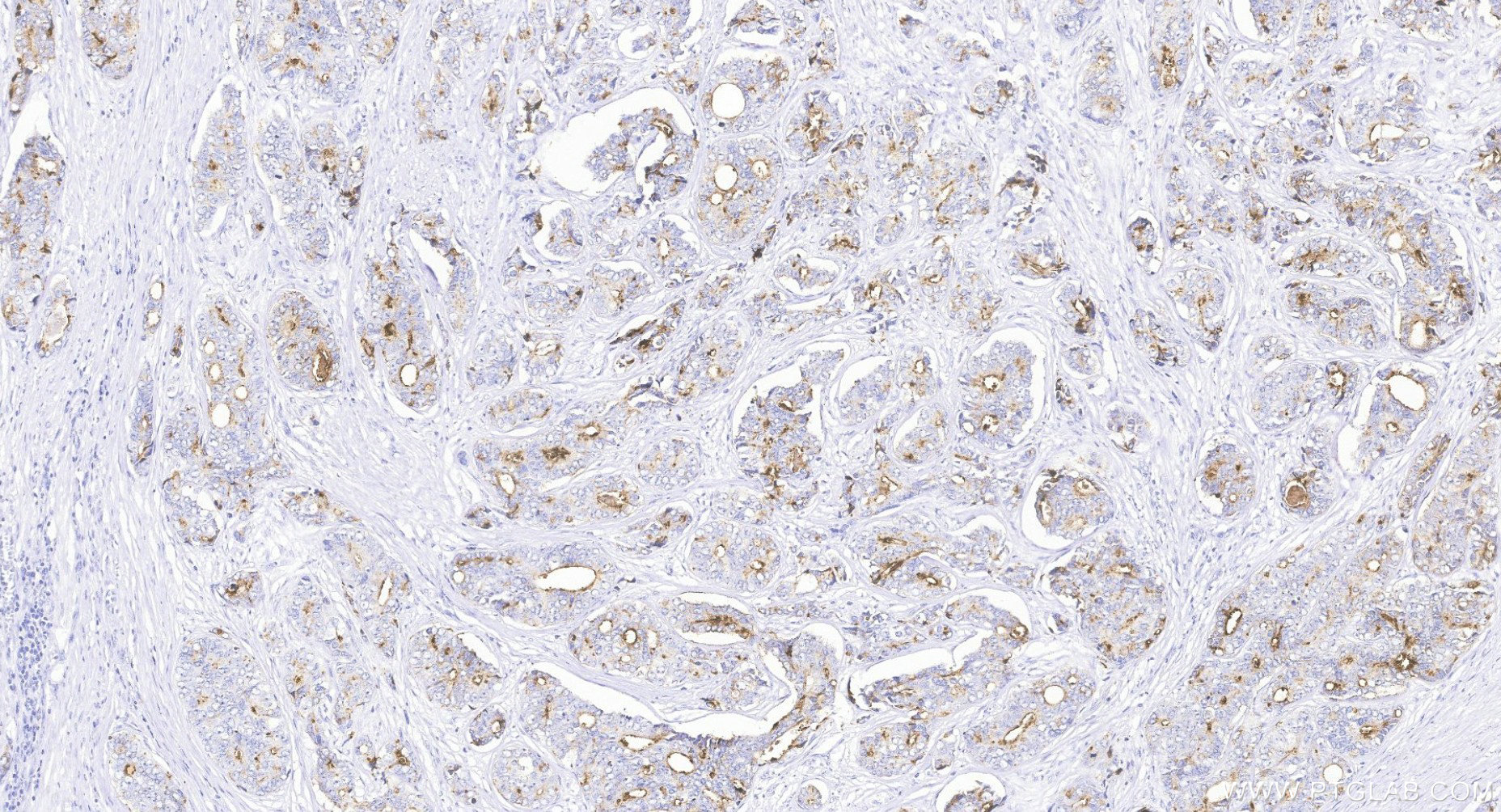 IHC staining of Human Prostate Cancer using 84059-7-RR IHC staining of Human Prostate Cancer using 84059-7-RR