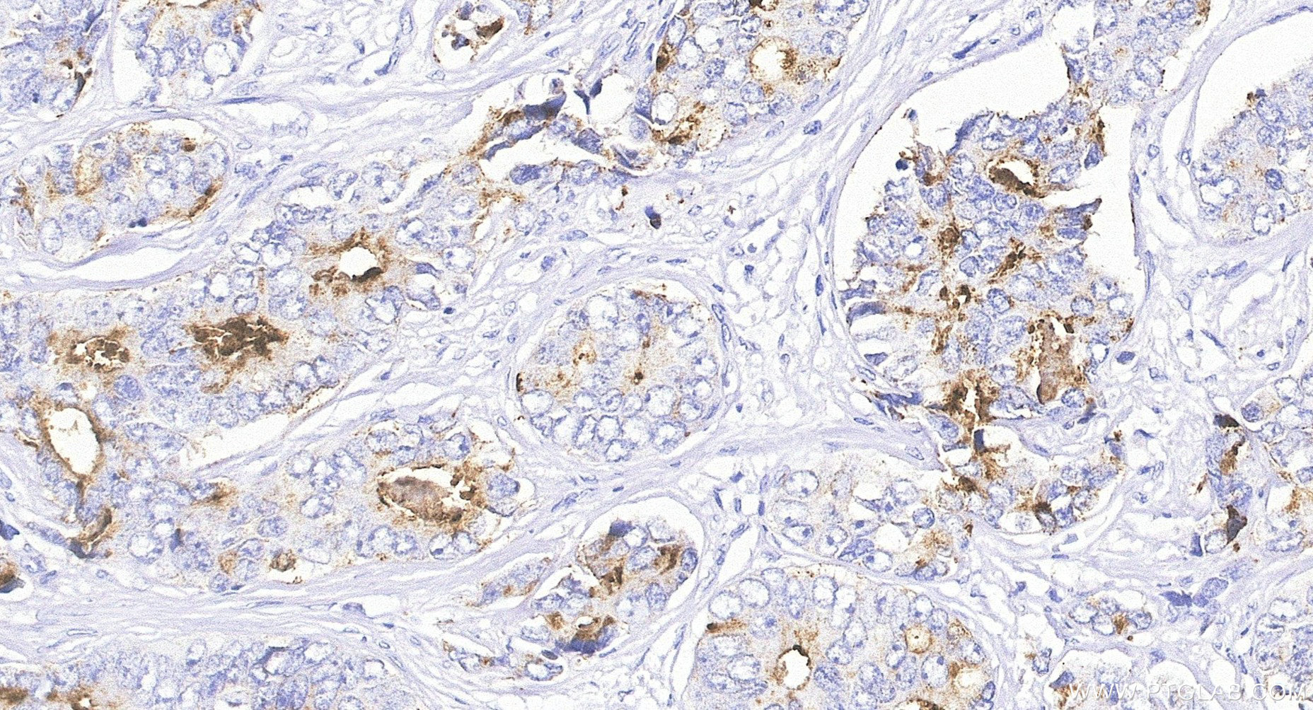 IHC staining of Human Prostate Cancer using 84059-7-RR IHC staining of Human Prostate Cancer using 84059-7-RR