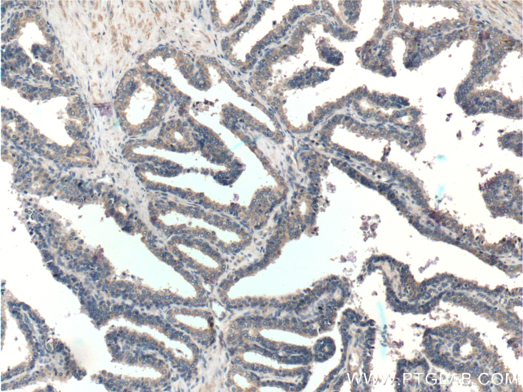 IHC staining of human prostate hyperplasia using 26547-1-AP