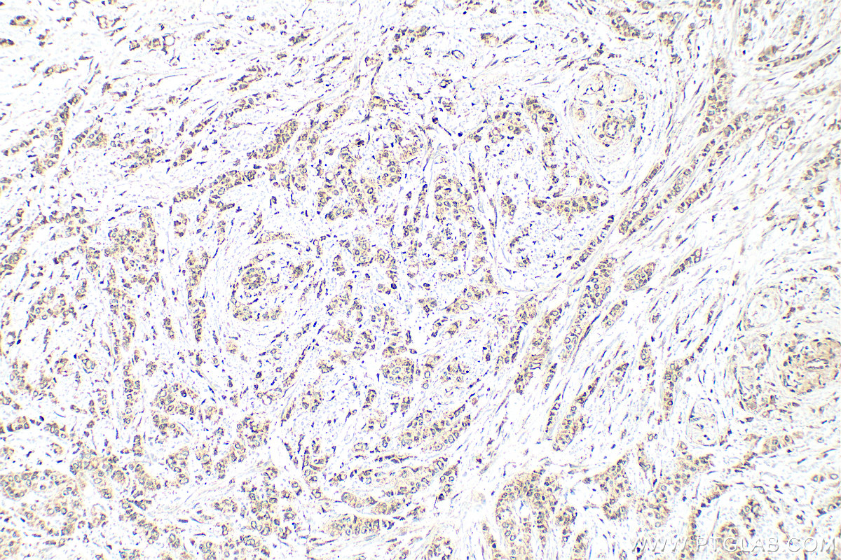 IHC staining of human breast cancer using 12264-1-AP IHC staining of human breast cancer using 12264-1-AP