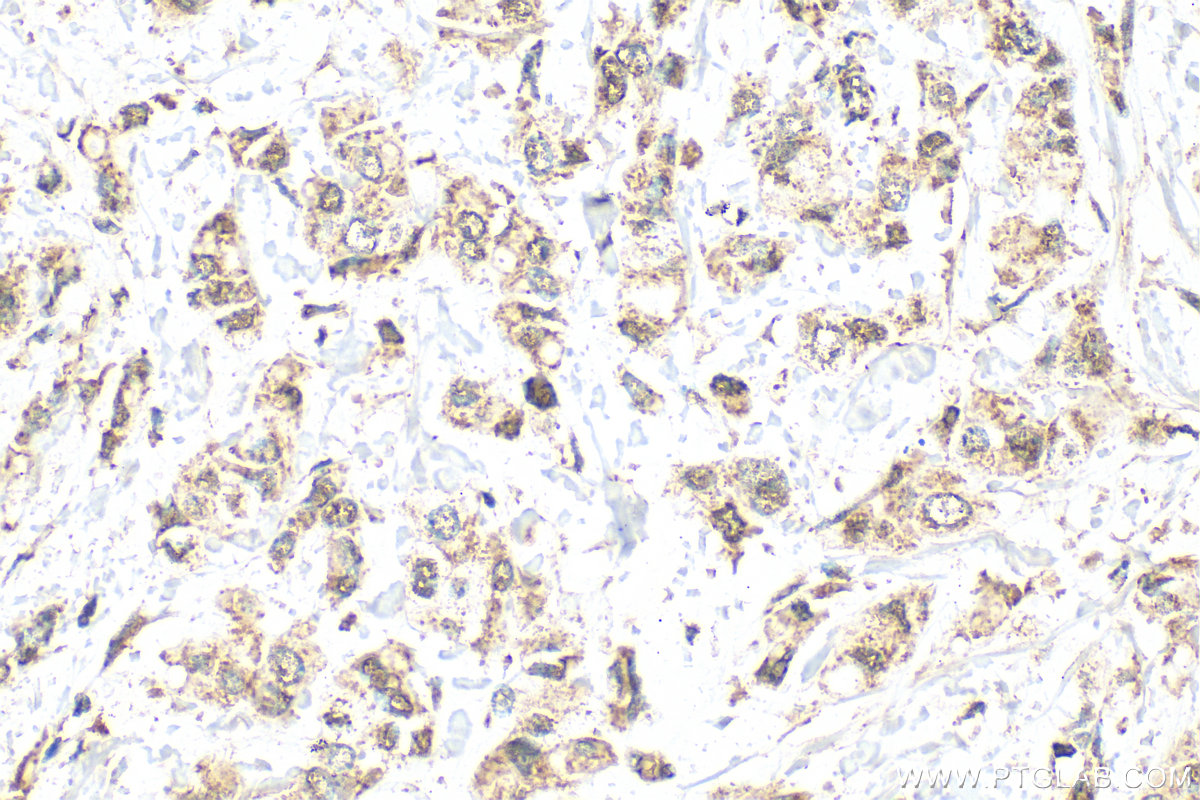 IHC staining of human breast cancer using 12264-1-AP IHC staining of human breast cancer using 12264-1-AP