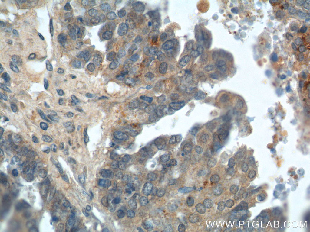 IHC staining of human ovary tumor using 14232-1-AP
