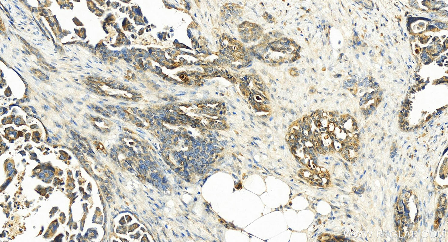 IHC staining of human ovary cancer using 14232-1-AP