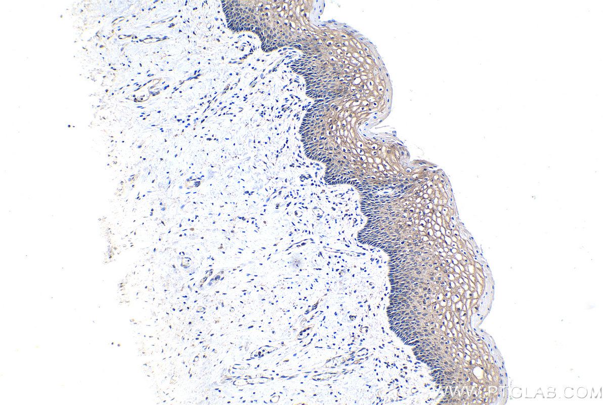 IHC staining of human cervical cancer using 68247-1-Ig (same clone as 68247-1-PBS)