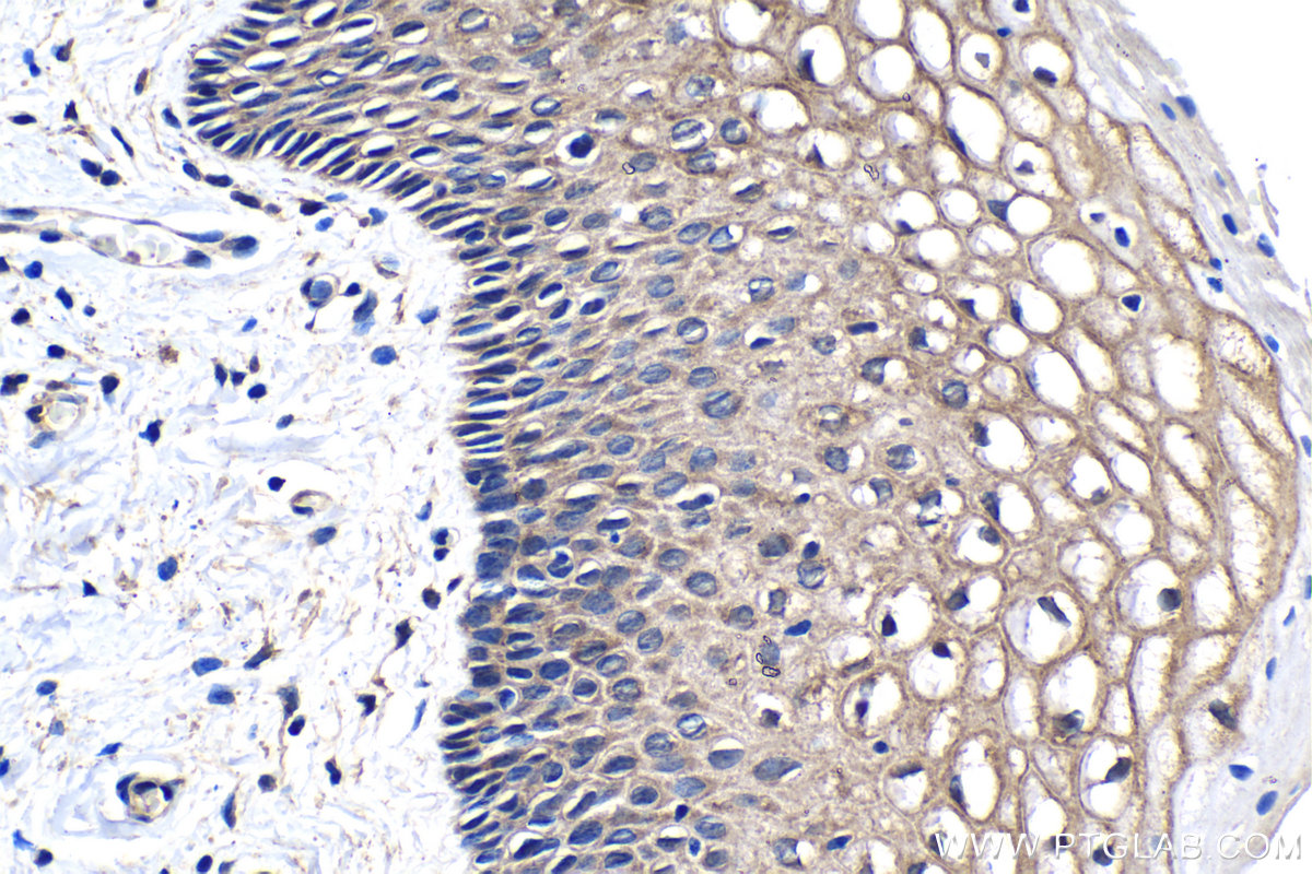 IHC staining of human cervical cancer using 68247-1-Ig (same clone as 68247-1-PBS)