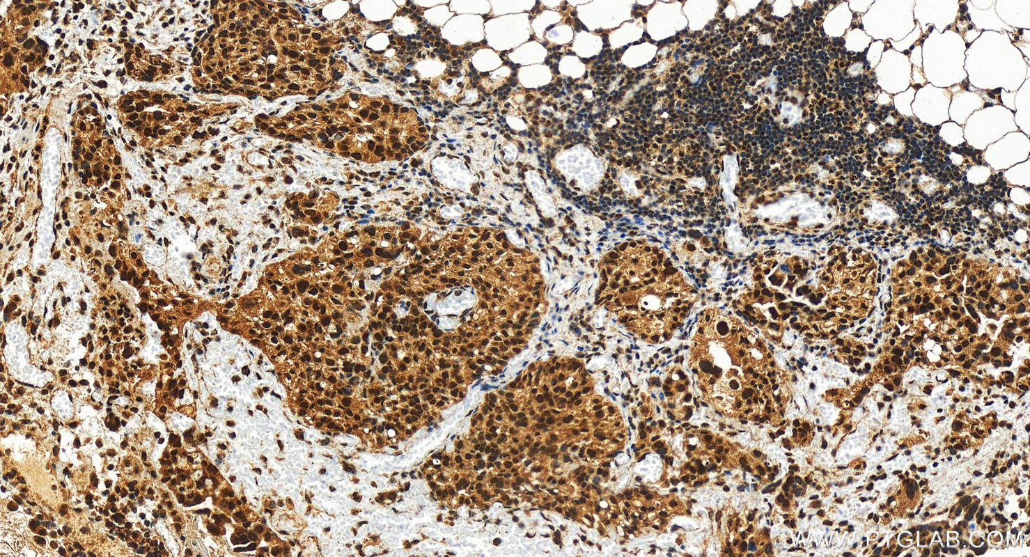 IHC staining of human ovary cancer using 28437-1-AP
