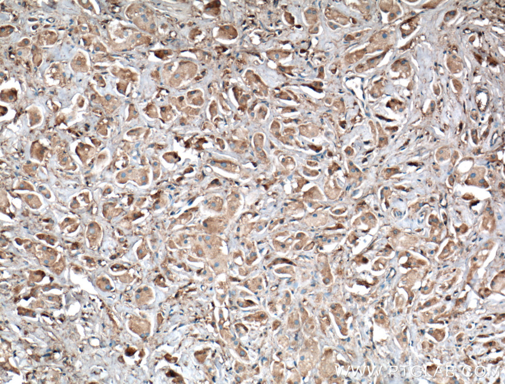 IHC staining of human breast cancer using 66123-1-Ig (same clone as 66123-1-PBS)