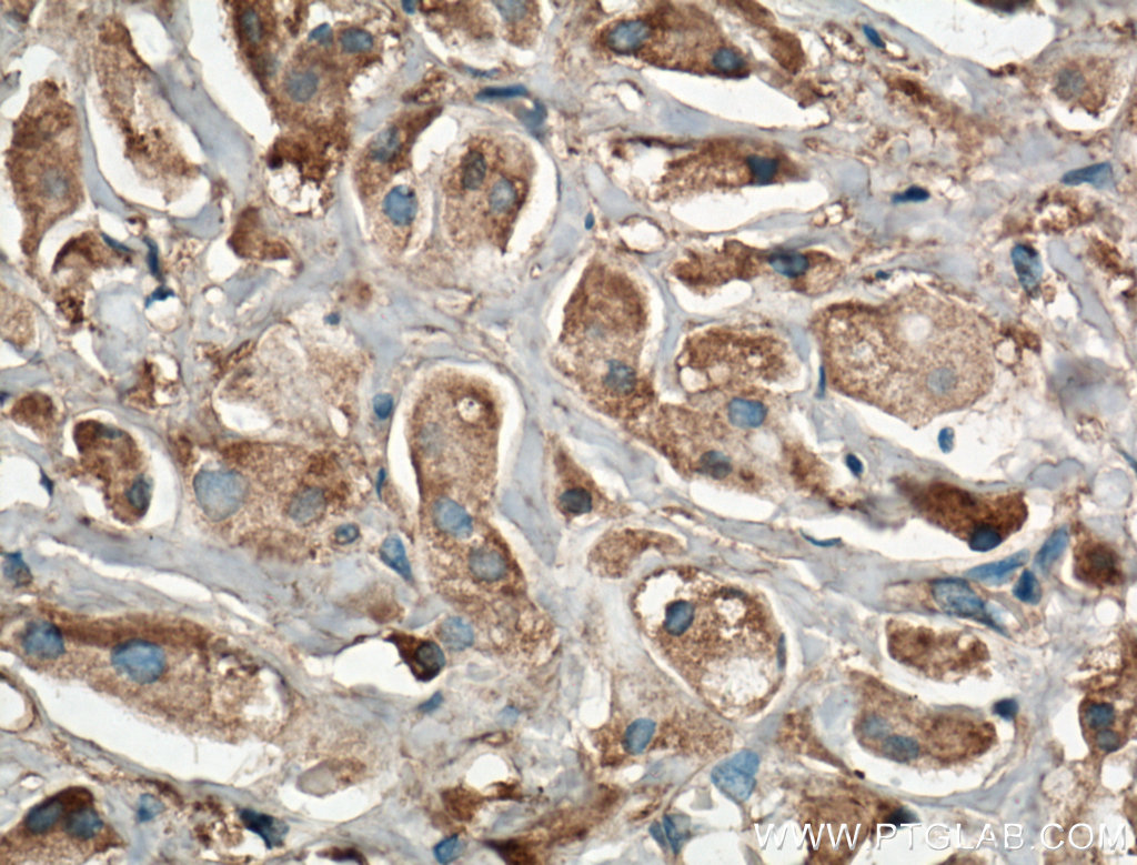 IHC staining of human breast cancer using 66123-1-Ig (same clone as 66123-1-PBS)
