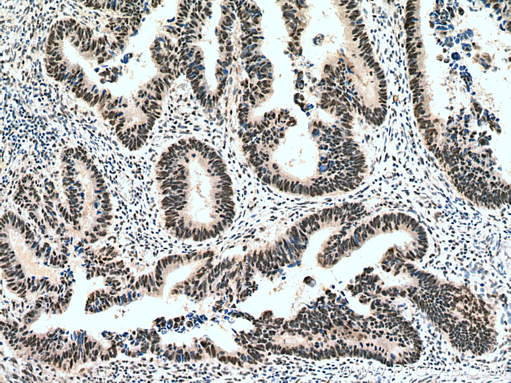 IHC staining of human colon cancer using 12463-1-AP