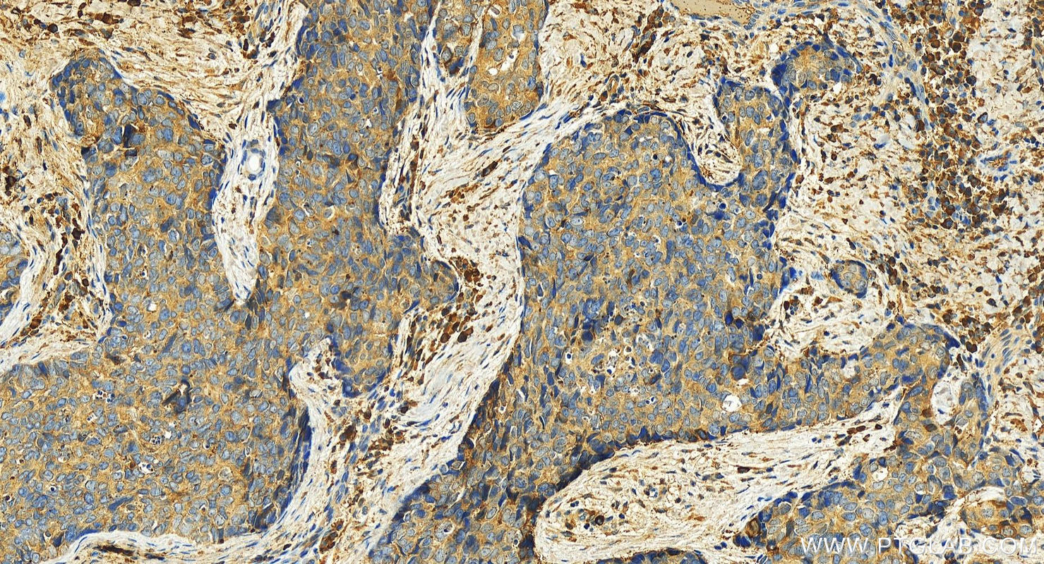 IHC staining of human bowen disease using 12463-1-AP