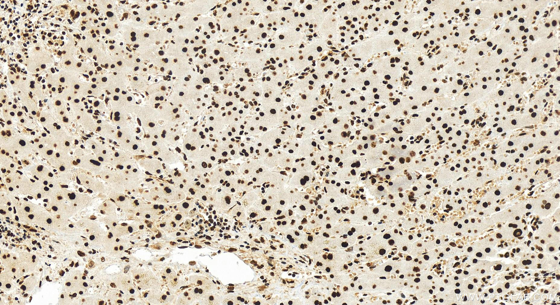 IHC staining of human intrahepatic cholangiocarcinoma using 82898-2-RR