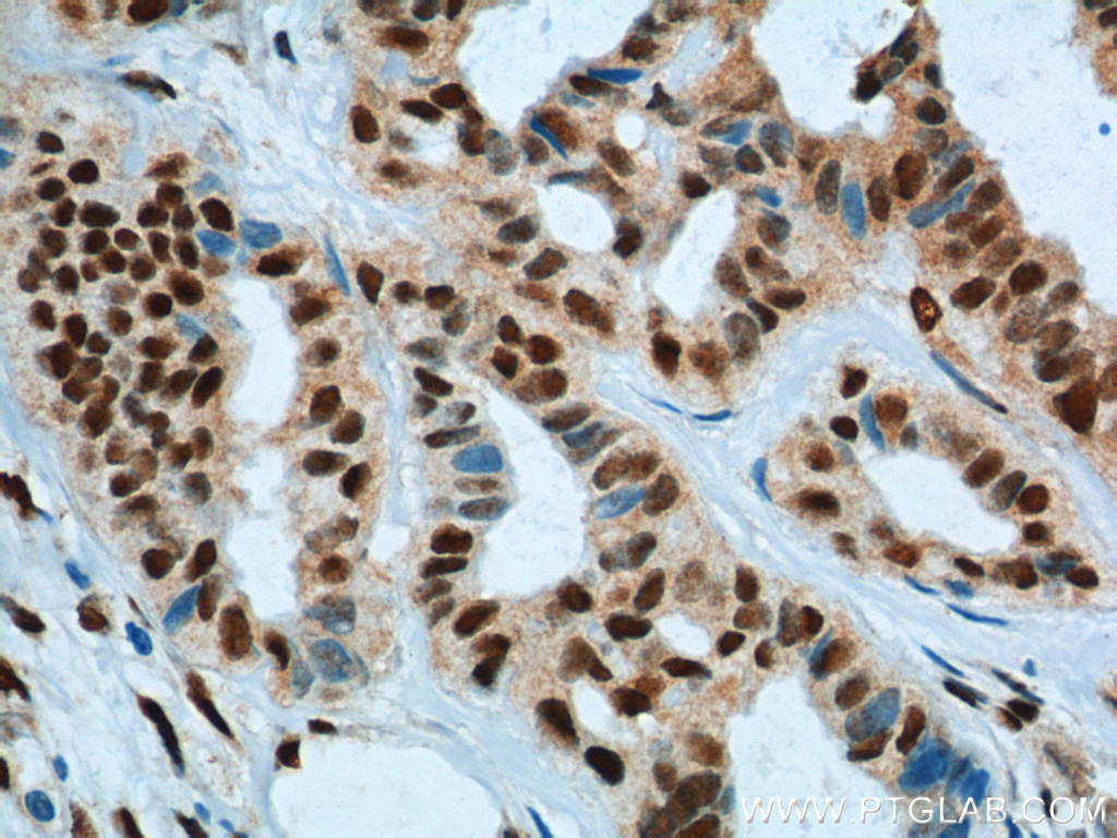 IHC staining of human breast cancer using 12366-2-AP