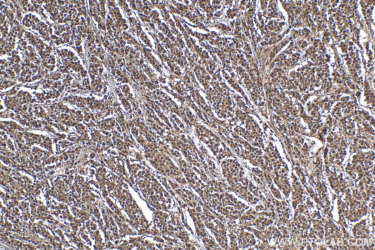 Immunohistochemical analysis of paraffin-embedded human colon cancer tissue slide using 10077-1-AP (Importin Beta antibody) at dilution of 1:200 (under 10x lens). Heat mediated antigen retrieval with Tris-EDTA buffer (pH 9.0). IHC staining of human colon cancer using 10077-1-AP