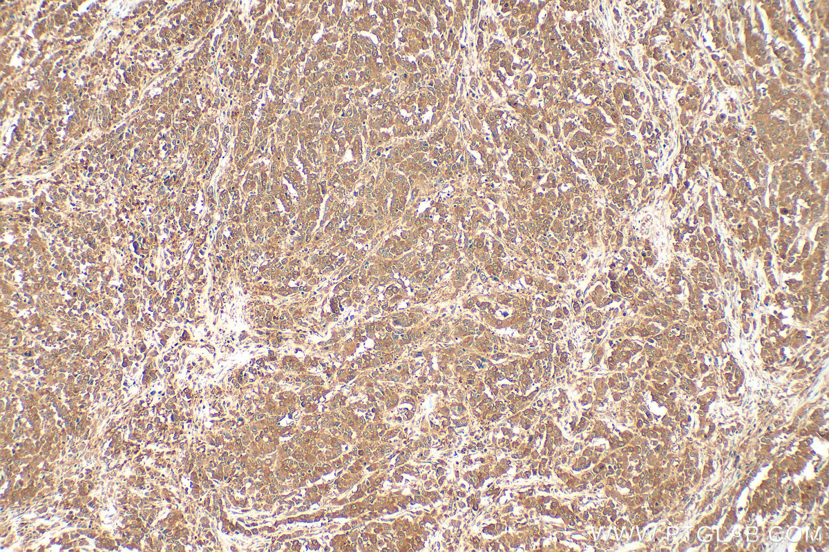 Immunohistochemical analysis of paraffin-embedded human colon cancer tissue slide using 12063-1-AP (KRAS antibody) at dilution of 1:200 (under 10x lens). Heat mediated antigen retrieval with Tris-EDTA buffer (pH 9.0). IHC staining of human colon cancer using 12063-1-AP