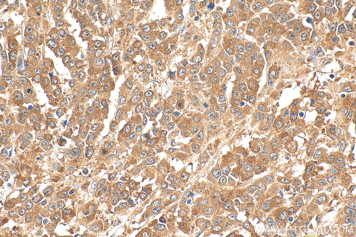 Immunohistochemical analysis of paraffin-embedded human colon cancer tissue slide using 12063-1-AP (KRAS antibody) at dilution of 1:200 (under 40x lens). Heat mediated antigen retrieval with Tris-EDTA buffer (pH 9.0). IHC staining of human colon cancer using 12063-1-AP