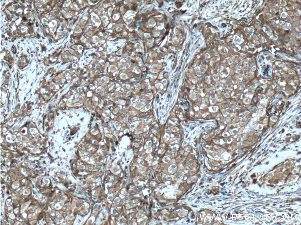 IHC staining of human breast cancer using 60309-1-Ig