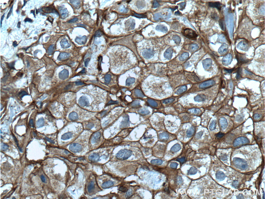 IHC staining of human breast cancer using 60309-1-Ig