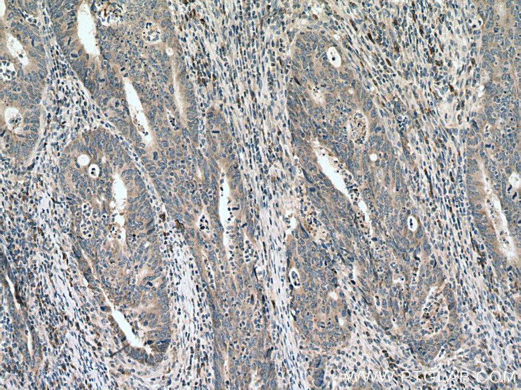 IHC staining of human colon cancer using 16155-1-AP
