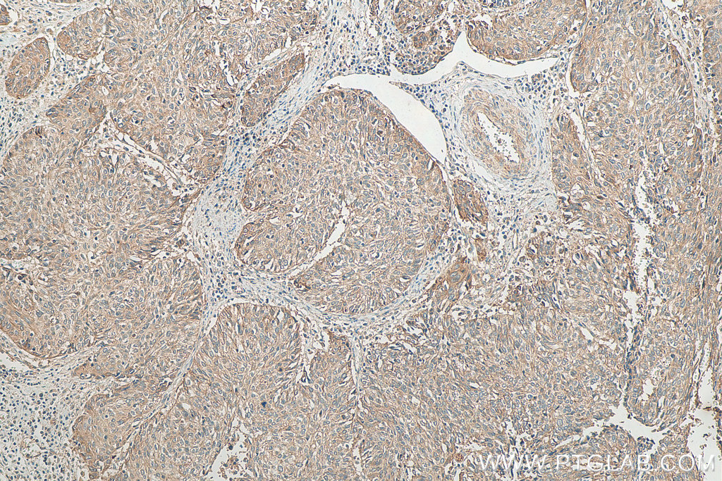 IHC staining of human cervical cancer using 16848-1-AP