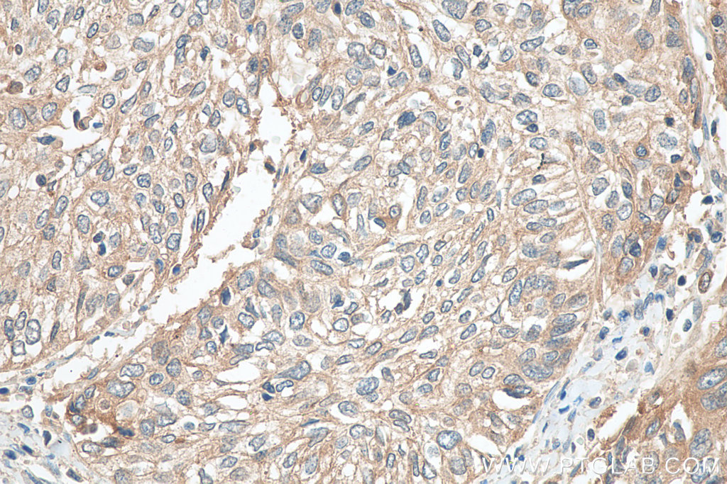 IHC staining of human cervical cancer using 16848-1-AP