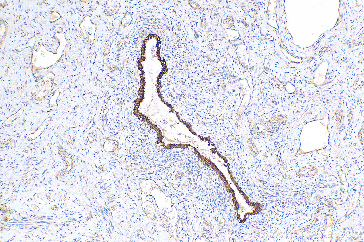 IHC staining of human cervical cancer using 18343-1-AP