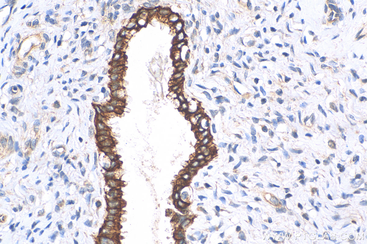 IHC staining of human cervical cancer using 18343-1-AP