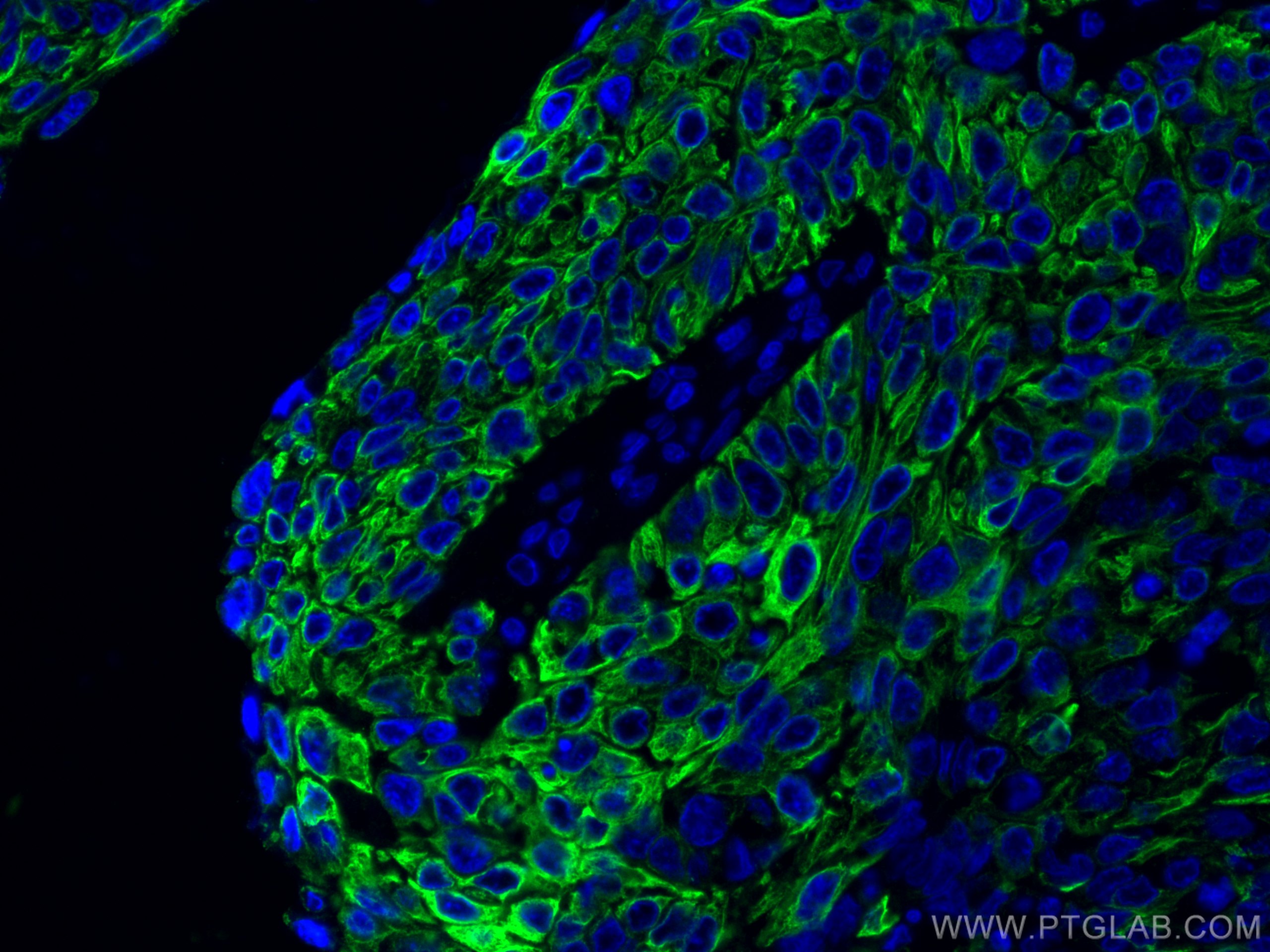 IF Staining of human cervical cancer using 66684-1-Ig (same clone as 66684-1-PBS)