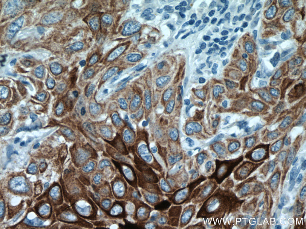 IHC staining of human cervical cancer using 66684-1-Ig (same clone as 66684-1-PBS)