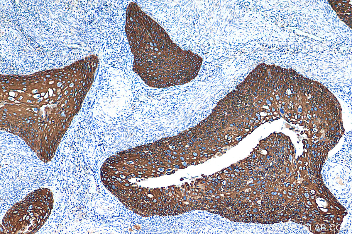 IHC staining of human cervical cancer using 66684-1-Ig (same clone as 66684-1-PBS)